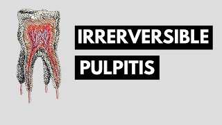 Irreversible pulpitis Introduction Clinical features amp Findings Radiology and Management [upl. by Artinahs]