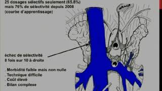 Prise en charge des hyperaldostéronismes primaires [upl. by Adlen]