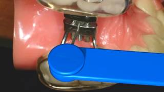 How to turn an RPE Rapid Palatal Expander  Nirenblatt Orthodontics [upl. by Ailalue]