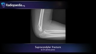 Supracondylar fracture  radiology video tutorial xray [upl. by Walton]