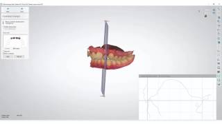 3Shape Ortho Analyzer  How to Measure Overjet and Overbite [upl. by Llerrot]