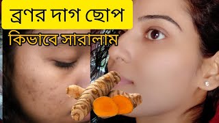 এইভাবে বাড়িতে ব্রণর কালো দাগ ছোপ থেকে চিরতরে মুক্তি  Kacha Holud Face Pack  Spotless Skin [upl. by Garneau]