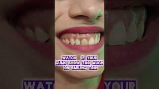 Watch if your Gums show too much on Smiling Dr Srishti Bhatia gummysmile smile laser [upl. by Lon769]