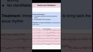 Ventricular Fibrillation [upl. by Attenal435]