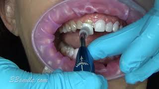 Prepless upper and lower Porcelain Dental Veneers [upl. by Kenna713]