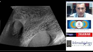 Fournier Gangrene Diagnosis teaching by Dr Arjun Kalyanpur [upl. by Aititel]