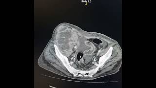 Pyonephrosis of transplanted kidney while atrophic fibrosed and calcified native kidneys [upl. by Caasi]