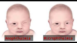 what is Anophthalmia  Microphthalmia  Terms means  Optometry solution [upl. by Hume]