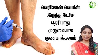 வெரிகோஸ் வெயின் இருந்த இடமே தெரியாது 100 குணமாக்கலாம் VARICOSE VEIN TREATMENT [upl. by Cirillo]