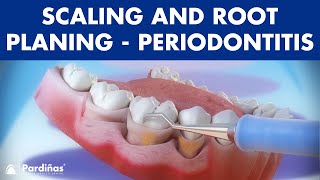 Treatment of periodontal disease  Scaling and root planing  Tartar © [upl. by Ardnic]