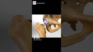 Total Hip Replacement Procedure  Animation [upl. by Dilks]