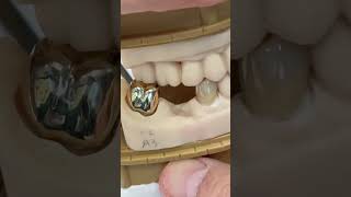 Zirconia vs 14 kt gold EnvisiontecMain envisiontec [upl. by Abbey]