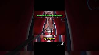 Removal of Thyroid Gland surgeryrecovery medicalstdents medical science surgeon [upl. by Peadar466]