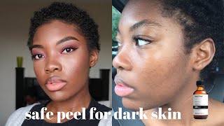 chemical peel at home for dark skin  chemical peel at home for acne [upl. by Assilaj217]