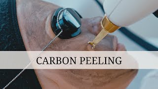 Carbon Peeling  Ordination Dr Gehl [upl. by Loyce788]