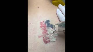 picosecond laser tattoo removal without leaving scars [upl. by Rambert]