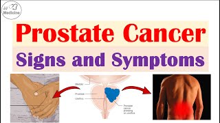 Prostate Cancer Signs and Symptoms Urinary Sexual amp Metastatic Symptoms [upl. by Saticilef436]