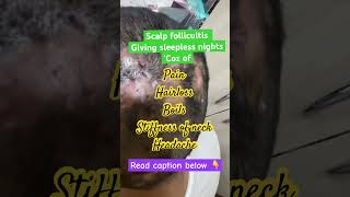 Scalp follicultis dermatologist in Punjab boils scalp infection parisaskinclinic drashimagoel [upl. by Oramug674]