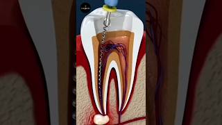 Root Canal Treatment science sciencefacts [upl. by Icart]