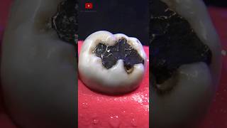 Restauración dental satisfying [upl. by Sitto402]