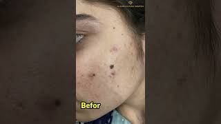 Mole Removal  Laser Mole Removal  how to remove moles from face AlShifa Future Hospital [upl. by Asiulairam]