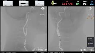 NV Connect  Carotid Artery Stenting [upl. by Nicholle]