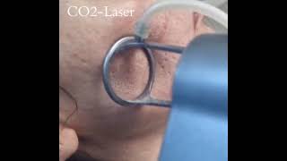 👍CO2 Laser Therapy [upl. by Arutak]