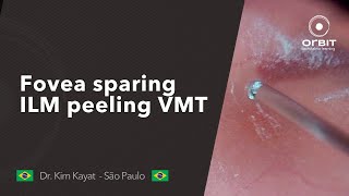 Orbit Tips 022 Fovea sparing ILM peeling VMT [upl. by Clabo]