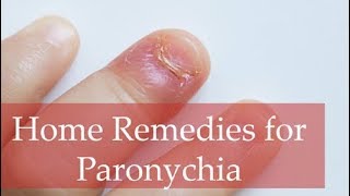 Top 6 Home Remedies for Paronychia and Best Home Treatment Methods [upl. by Ralfston]