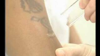 Laser Tattoo Removal on Dark Skin with the MedLite [upl. by Oaks]