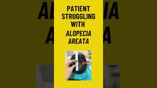 Alopecia Areata Treatment amp Result 😍 alopecia drshalupunj haircare [upl. by Carpet191]