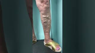 Treatment of LARGE Varicose Veins [upl. by Robins305]