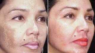 TRATAMENTO PARA MELASMA  CREME JAPONES [upl. by Yenetruoc]