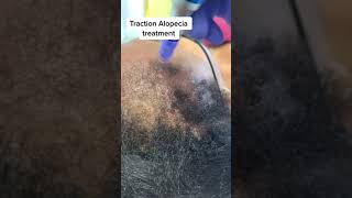 Microneedling Traction alopecia treatment [upl. by Leighland366]