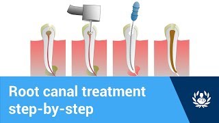 What are the steps of root canal treatment [upl. by Olnee]