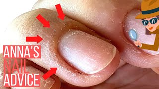 THINKING ABOUT GEL POLISH YOU NEED TO KNOW WHY THIS HAPPENS ALLERGIC REACTIONS amp OVEREXPOSURE [upl. by Stag]