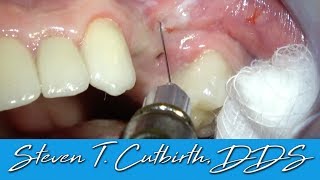 Painless and Profound Maxillary Local Anesthesia  Dental Minute with Steven T Cutbirth DDS [upl. by Drofhsa]