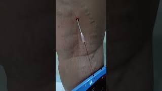 varicosevein unani varicoseveinstreatment drhussain Greekcliniccom nosurgery [upl. by Eillak792]