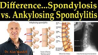 The Difference Between Spondylosis amp Ankylosing Spondylitis  Dr Alan Mandell DC [upl. by Ienttirb]