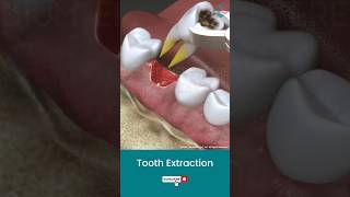 Tooth Extraction Procedure ↪ 3D Medical Animation Shorts Tooth ToothExtraction [upl. by Aihpledalihp]