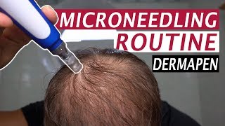 My Microneedling Routine and Derma Rolling for Hair Loss [upl. by Ettenej60]