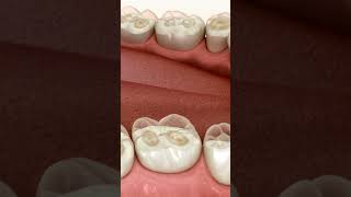 Dental Erosion Prevalence Incidence and Distribution  Pocket  dentist dentistteeth [upl. by Tenenbaum]