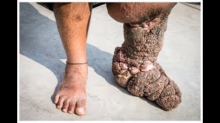 Filariasis or elephantiasis causes symptoms and treatment [upl. by Cavill]