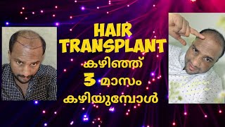 Hair Transplant finish After 3 month Result 😇😇 [upl. by Daggett]