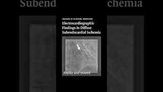 Images in Clinical Medicine Electrocardiographic Findings in Diffuse Subendocardial Ischemia [upl. by Nileak245]