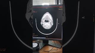 CT SCAN OF BRAIN ANGIOGRAPHYmedical shortfeedsviralmillion 1000subscriberctscan angiography [upl. by Eniortna960]