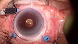 Macular Pucker Surgery [upl. by Inafit338]