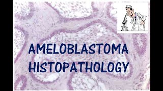 AMELOBLASTOMA HISTOPATHOLOGY I ORAL PATHOLOGY [upl. by Omer504]