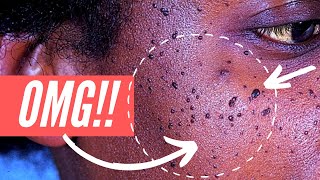 Why am I getting so many moles on my FACE Dermatosis Papulosa Nigra explained [upl. by Bovill342]