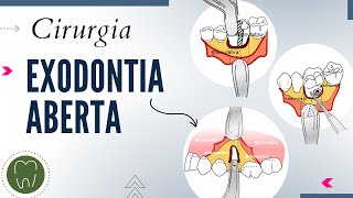 CIRURGIA ABERTA  SOUZA BRU [upl. by Ainatnas]